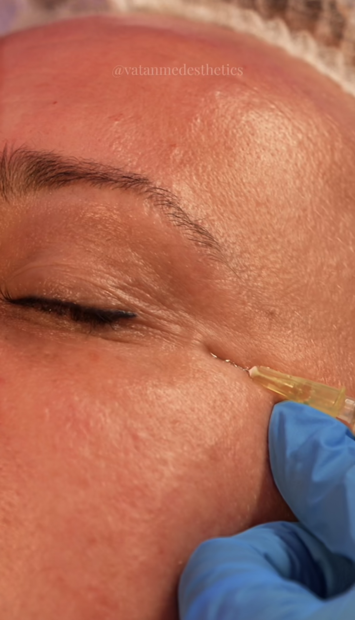 Mezoterapia i PRP — zabieg